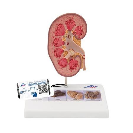3B SCIENTIFIC Kidney Stone Model - w/ 3B Smart Anatomy 1000316